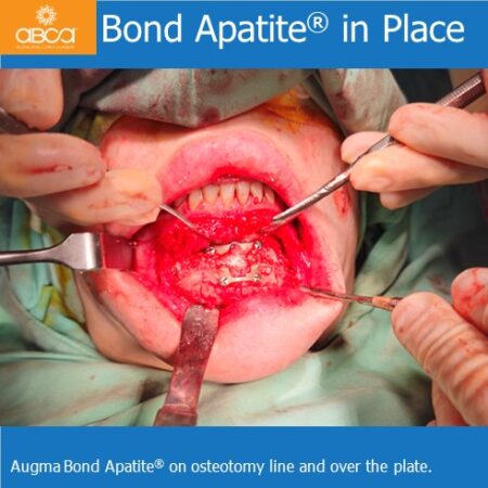 Advancement Genioplasty Utilizing Augma Bond ApatiteŽ