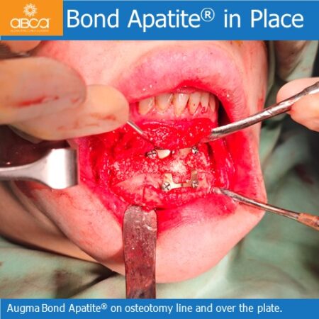 Advancement Genioplasty Utilizing Augma Bond ApatiteŽ