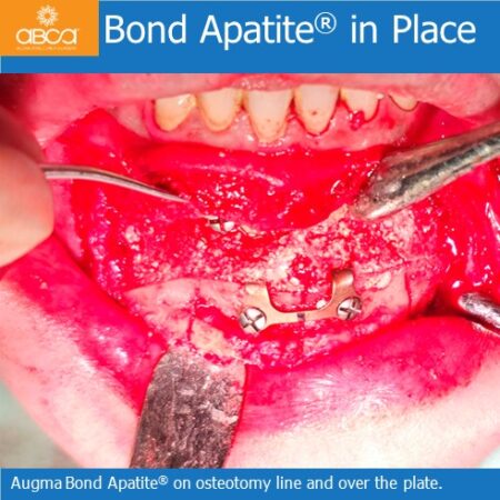 Advancement Genioplasty Utilizing Augma Bond ApatiteŽ