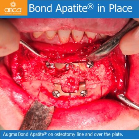 Advancement Genioplasty Utilizing Augma Bond ApatiteŽ