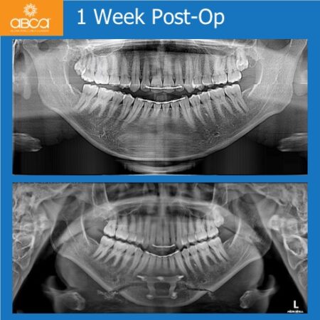 Advancement Genioplasty Utilizing Augma Bond ApatiteŽ