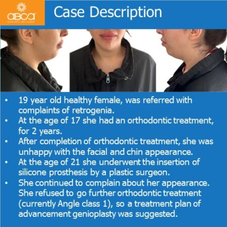 Advancement Genioplasty Utilizing Augma Bond ApatiteŽ