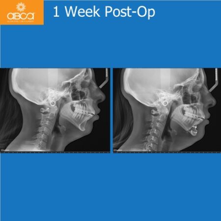 Advancement Genioplasty Utilizing Augma Bond ApatiteŽ