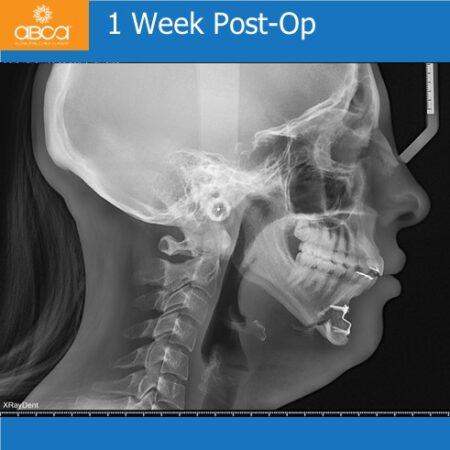 Advancement Genioplasty Utilizing Augma Bond ApatiteŽ