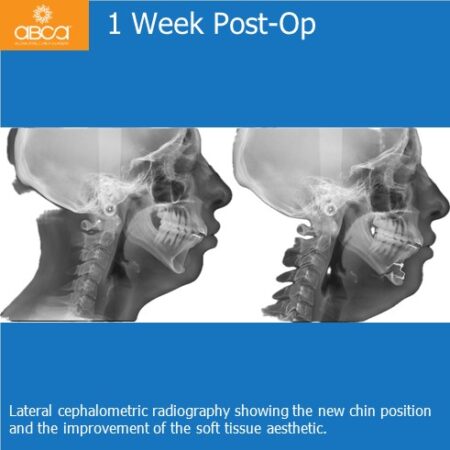 Advancement Genioplasty Utilizing Augma Bond ApatiteŽ