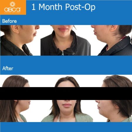 Advancement Genioplasty Utilizing Augma Bond ApatiteŽ