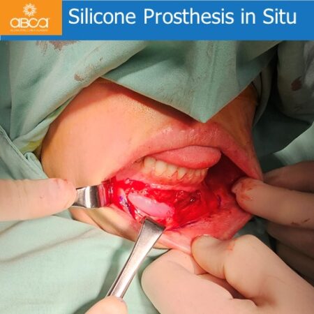 Advancement Genioplasty Utilizing Augma Bond ApatiteŽ