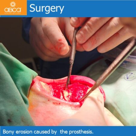 Advancement Genioplasty Utilizing Augma Bond ApatiteŽ