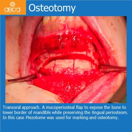 Advancement Genioplasty Utilizing Augma Bond ApatiteŽ