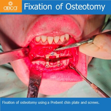 Advancement Genioplasty Utilizing Augma Bond ApatiteŽ