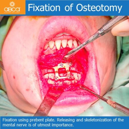 Advancement Genioplasty Utilizing Augma Bond ApatiteŽ