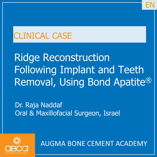 Ridge Reconstruction Following Implant and Teeth Removal, using Bond Apatite
