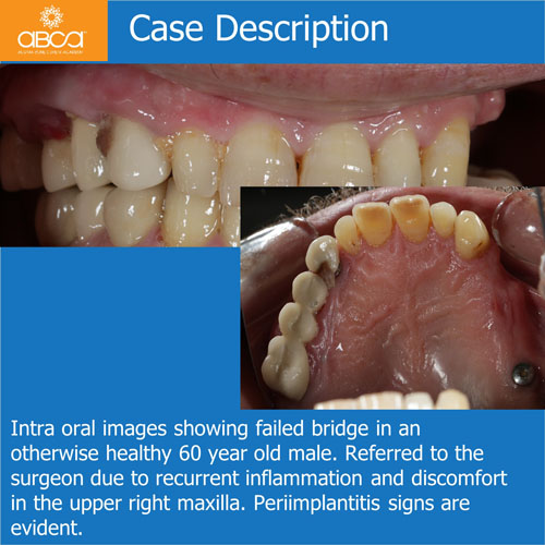 Ridge Reconstruction Following Implant and Teeth Removal, using Bond Apatite