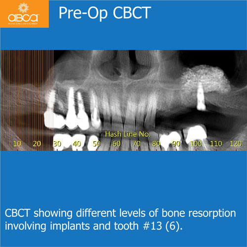 Ridge Reconstruction Following Implant and Teeth Removal, using Bond Apatite