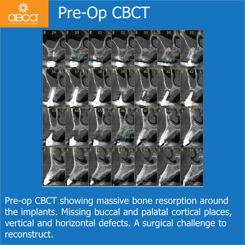 Ridge Reconstruction Following Implant and Teeth Removal, using Bond Apatite