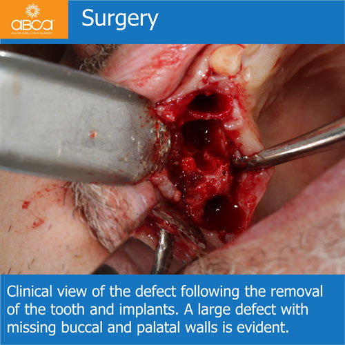 Ridge Reconstruction Following Implant and Teeth Removal, using Bond Apatite