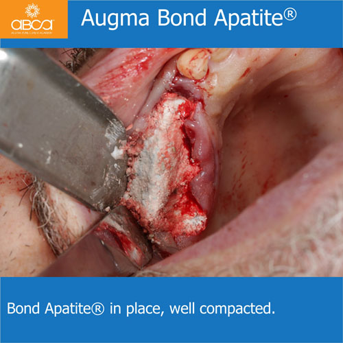 Ridge Reconstruction Following Implant and Teeth Removal, using Bond Apatite