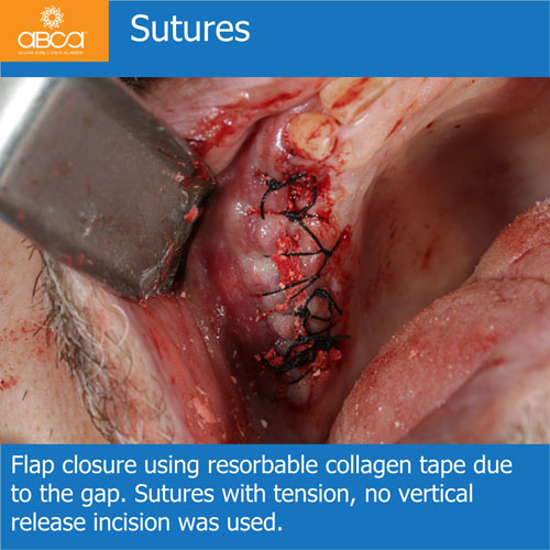 Ridge Reconstruction Following Implant and Teeth Removal, using Bond Apatite