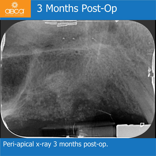 Ridge Reconstruction Following Implant and Teeth Removal, using Bond Apatite