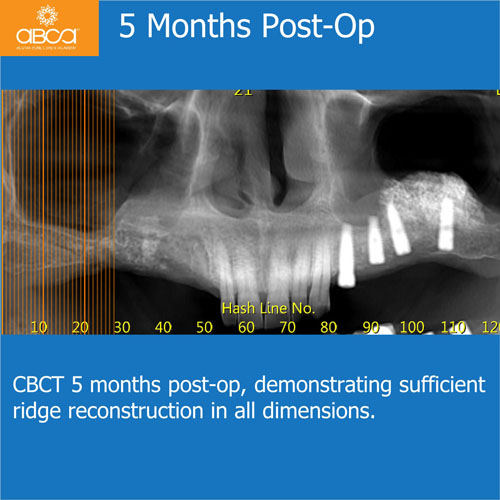 Ridge Reconstruction Following Implant and Teeth Removal, using Bond Apatite