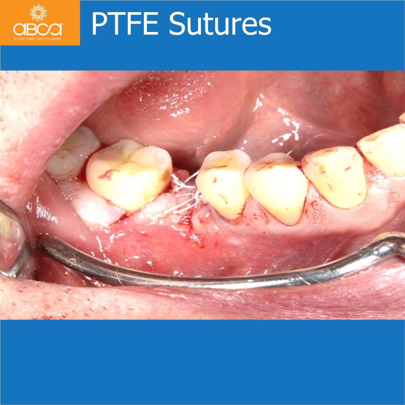 PTFE Sutures