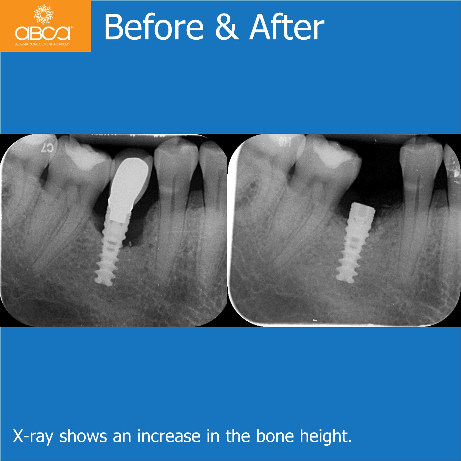 Before & After - X-ray shows an increase in the bone height