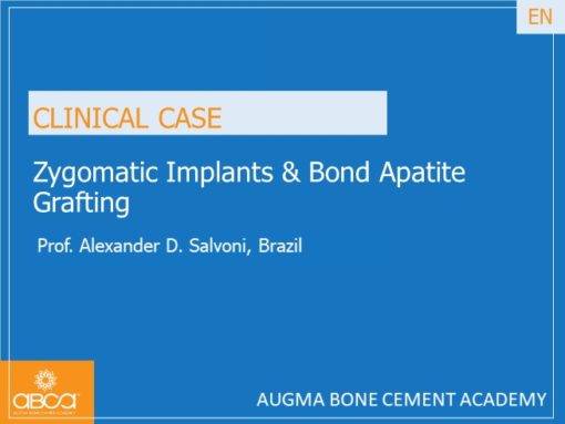 Zygomatic Implants & Bond Apatite Grafting
