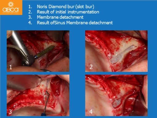 Zygomatic Implants & Bond Apatite Grafting