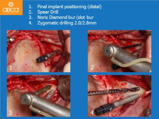 Zygomatic Implants & Bond Apatite Grafting