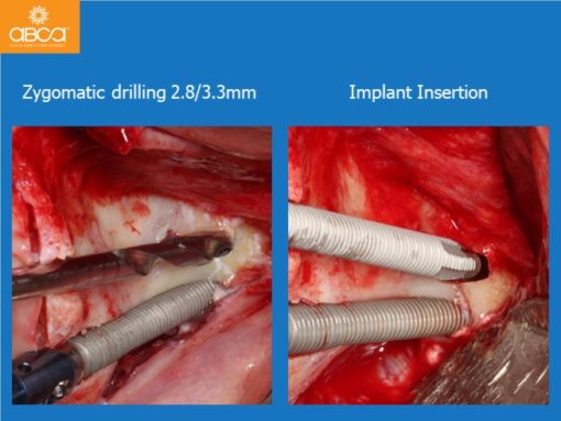 Zygomatic Implants & Bond Apatite Grafting
