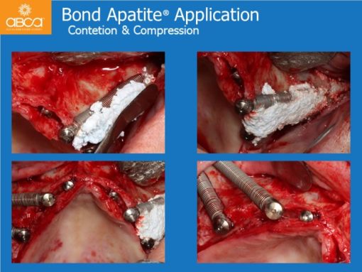 Zygomatic Implants & Bond Apatite Grafting