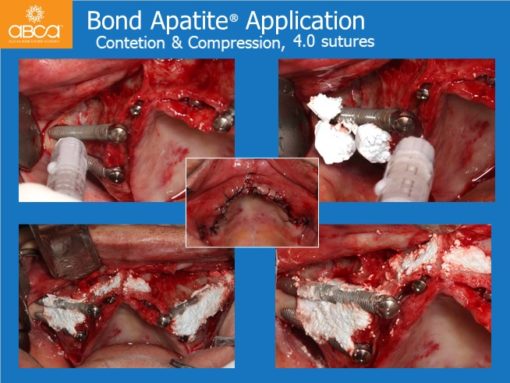 Zygomatic Implants & Bond Apatite Grafting