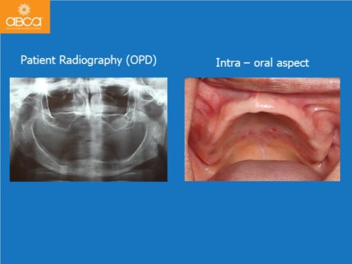 Zygomatic Implants & Bond Apatite Grafting