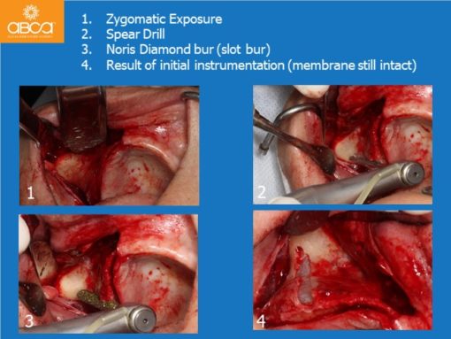 Zygomatic Implants & Bond Apatite Grafting