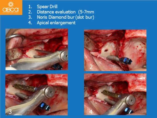 Zygomatic Implants & Bond Apatite Grafting