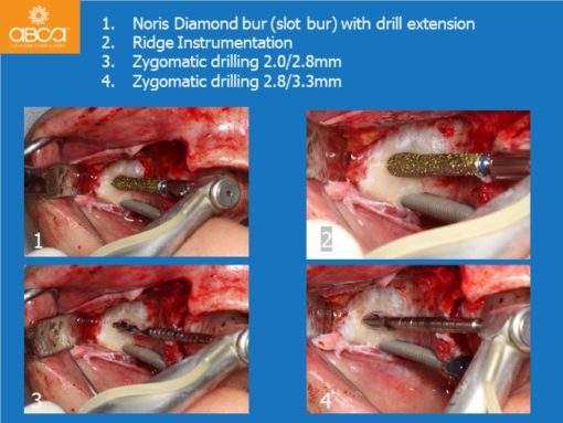 Zygomatic Implants & Bond Apatite Grafting