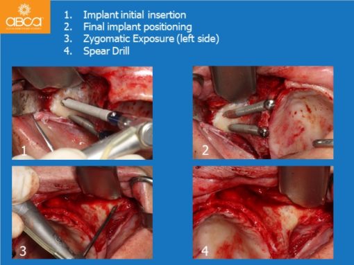 Zygomatic Implants & Bond Apatite Grafting