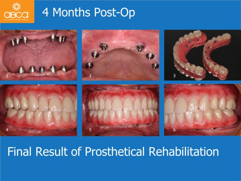 Zygomatic Implants & Bond Apatite Grafting