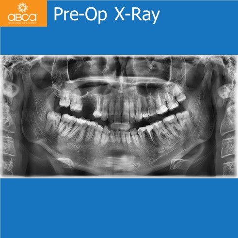 Pre-Op X-Ray