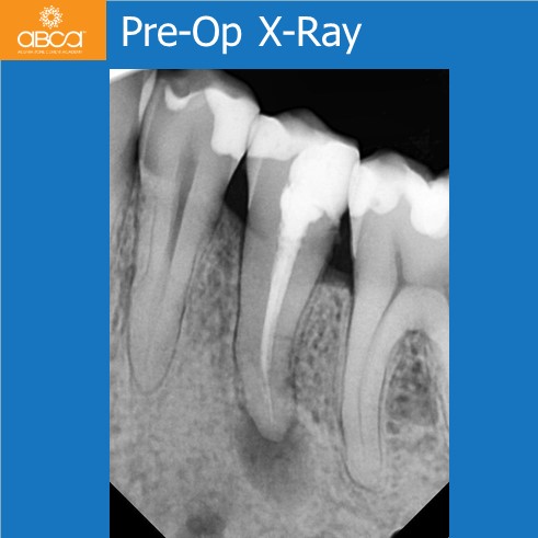 Pre-Op X-Ray