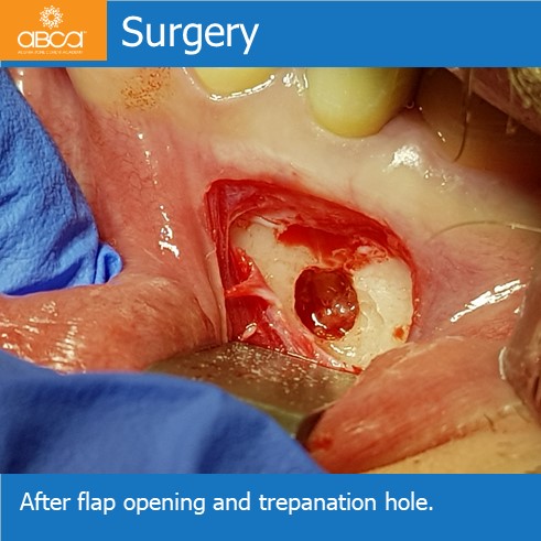 Surgery - After flap opening and trepanation hole