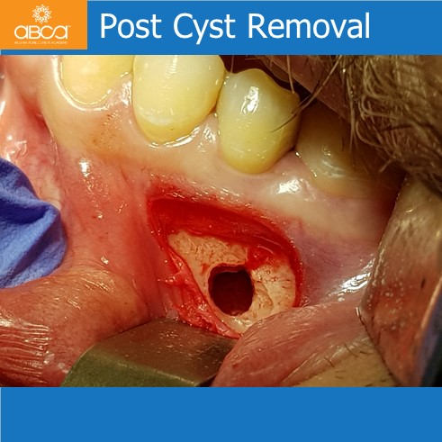 Post Cyst Removal
