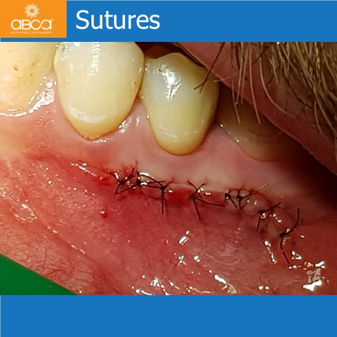 Sutures