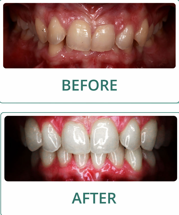 K Clear Aligners Before and After