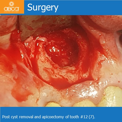 Large Cyst of the Front Right Maxilla