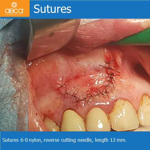 Large Cyst of the Front Right Maxilla