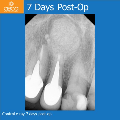 Large Cyst of the Front Right Maxilla