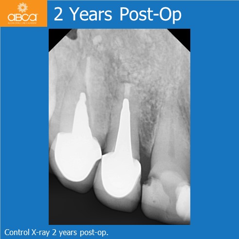 Large Cyst of the Front Right Maxilla