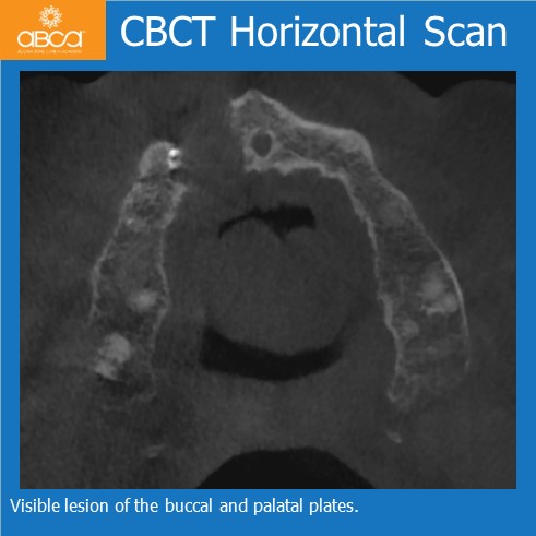 Large Cyst of the Front Right Maxilla