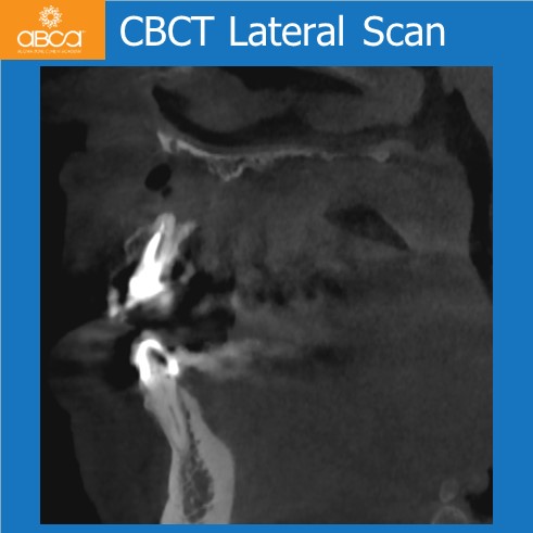 Large Cyst of the Front Right Maxilla